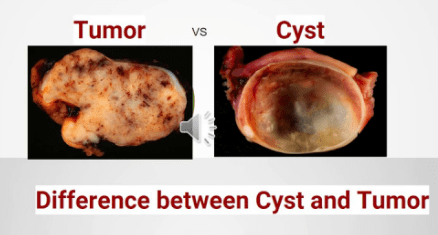 Difference between a Cyst and Tumor